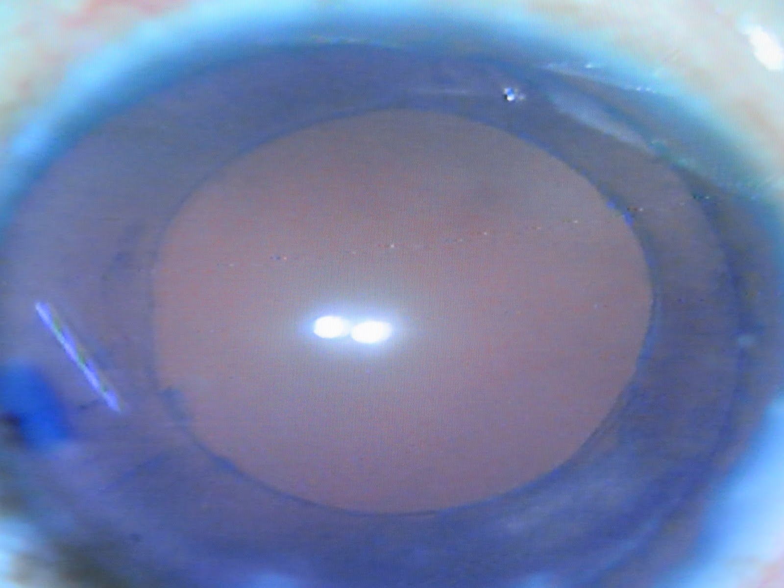 Zepto Cataract Surgery and TRiDIFF Trifocal IOL in intumescent Cataract