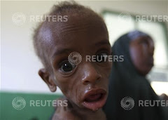 Heartbreaking Photos of Malnourished Children Dying in Somali Famine
