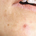 7 Causes of Acne Nodule On Face