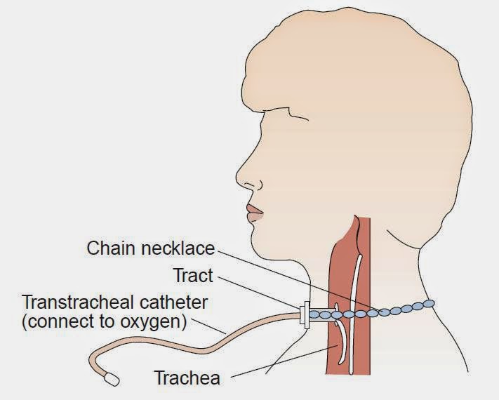 Transtracheal Oxygenation Nursing