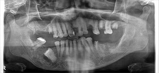 dental panoramic x-ray showing many teeth requiring fillings Dr Adel Zakhary
