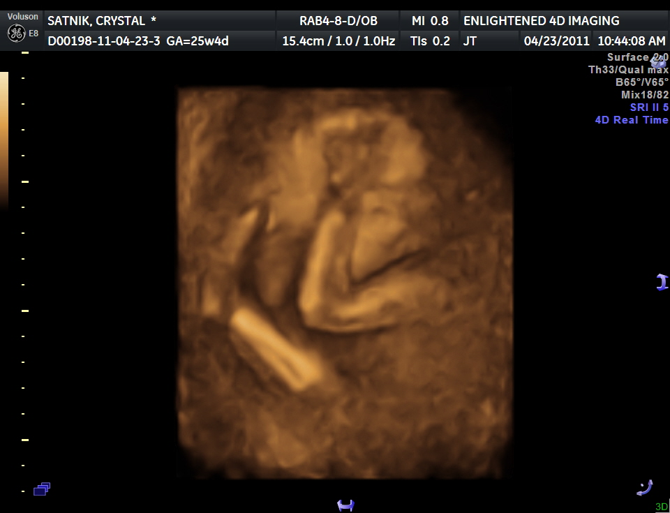 mercurux: 3d ultrasound pictures at 26 weeks