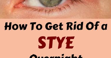 How To Get Rid Of a Stye Overnight - Sweet Oh Joy