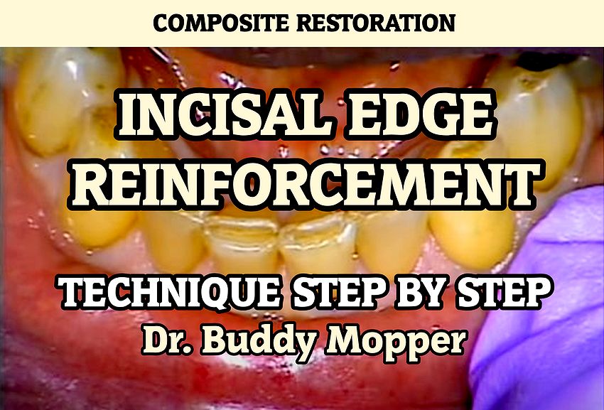 INCISAL EDGE REINFORCEMENT Technique step by step Dr. Buddy Mopper