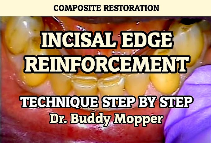 INCISAL EDGE REINFORCEMENT: Technique step by step - Dr. Buddy Mopper