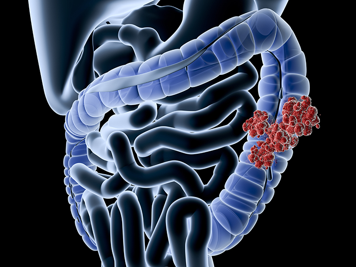Colon Cancer, here is what you need to know
