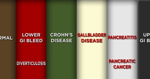 Gastroparesis Poop What The Different Colors And Smells Mean