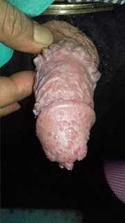 Obat Kutil Kelamin Murah Obat Kutil Kelamin Murah