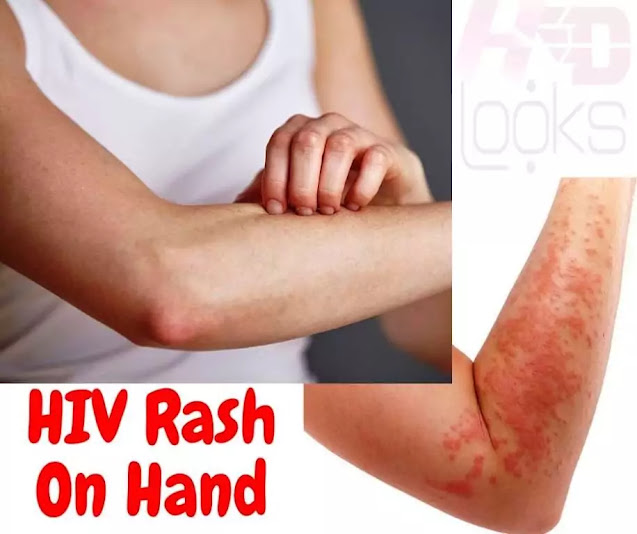 HIV RASH ON HAND hiv rash on hand