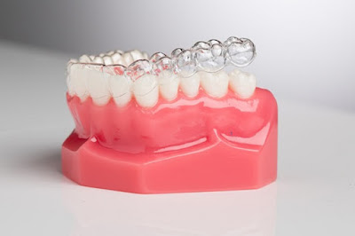 Kỹ thuật niềng răng không nhổ răng