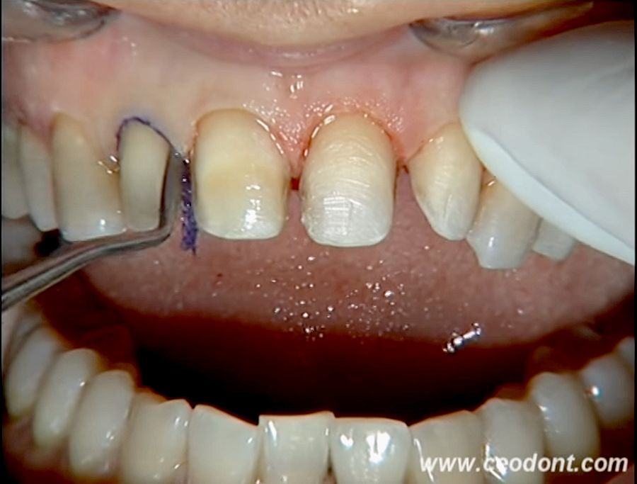 carillas dentales archivos - Clinica Dental Cuadrado