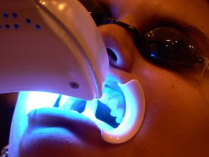 Tẩy trắng răng bằng đèn plasma