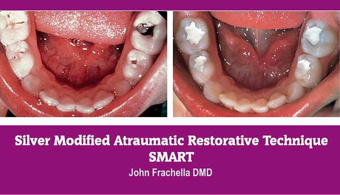 SMART: Silver Modified Atraumatic Restorative Technique - John Frachella DMD