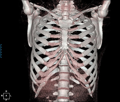 Systemic Candida: Bone Pain and Rib #10