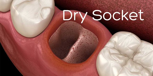 What is Dry Socket? Causes, Symptoms, Treatment, Prevention