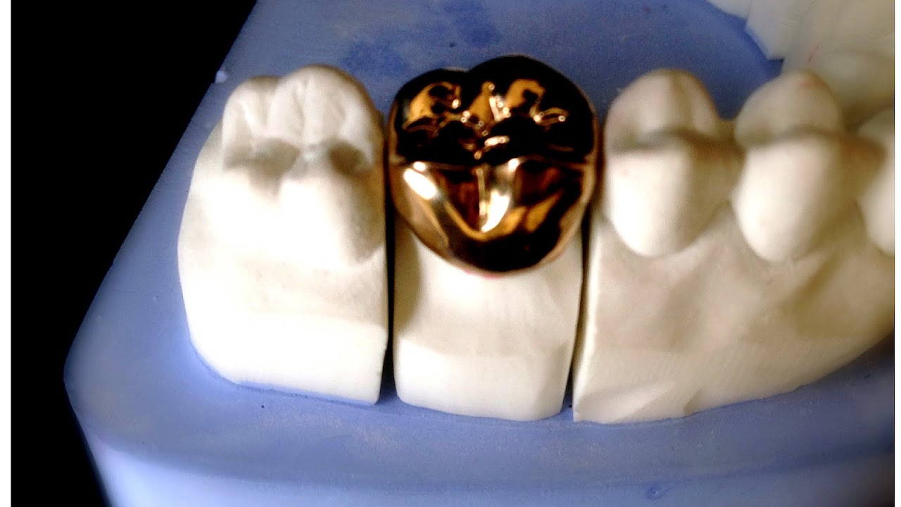 Gold Crown Dental Gold Choices