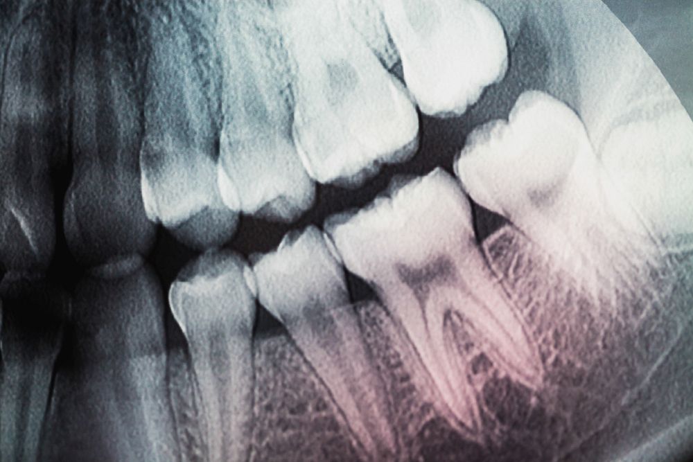 The Importance of Dental Xrays Directorio Odontológico