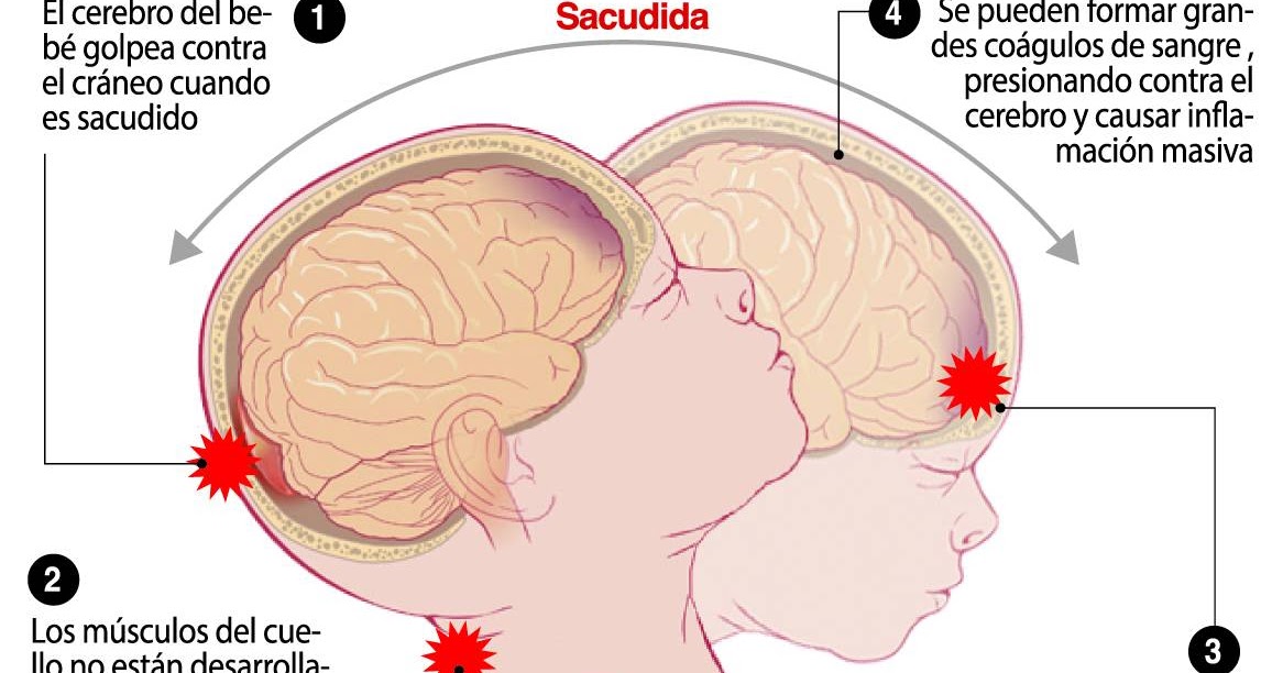 EMS SOLUTIONS INTERNATIONAL marca registrada “Síndrome del Bebé