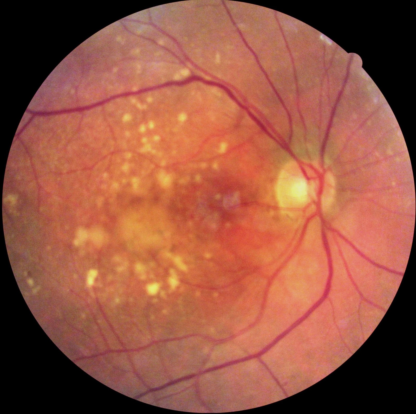 Can Exercise Decrease the Risk of Macular Degeneration? Eyedolatry