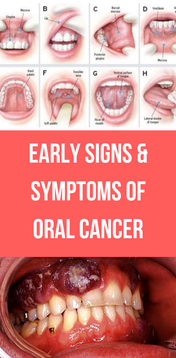 Early Signs And Symptoms Of Oral Cancer Health News