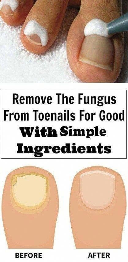 9 Simple Ingredients to Remove The Fungus From Toenails | Healthy Clean 100