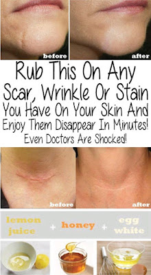 Rub This On Any Scar, Wrinkle Or Stain You Have On Your Skin And Enjoy Them Disappear In Minutes! Even Doctors Are Shocked!