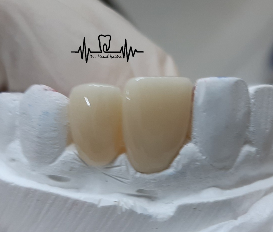 Amazing facts about zirconia crowns