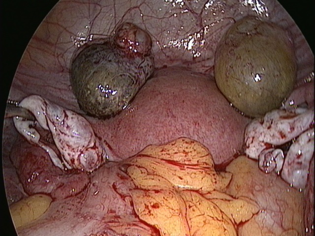 hairy ovarian cyst Wife sex mwv
