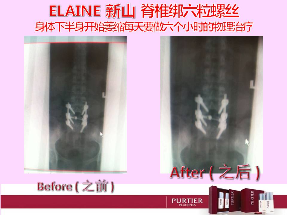 ELAIN (JB)-SPINAL CORD DAMAGE,INSTALL 6 SCREW,IMBALANCE OF BOTH LEGS,PHYSIOTHERAPY 6 HRS DAILY