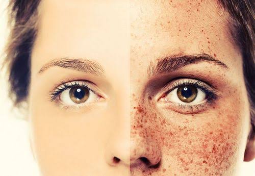 How to get rid of freckles permanently