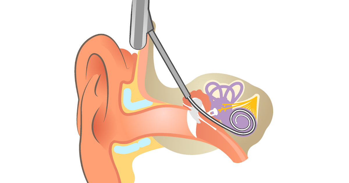 Implante coclear Doctiplus salud en línea
