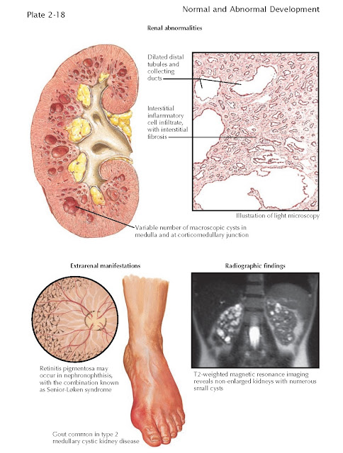 NEPHRONOPHTHISIS/MEDULLARY CYSTIC KIDNEY DISEASE COMPLEX