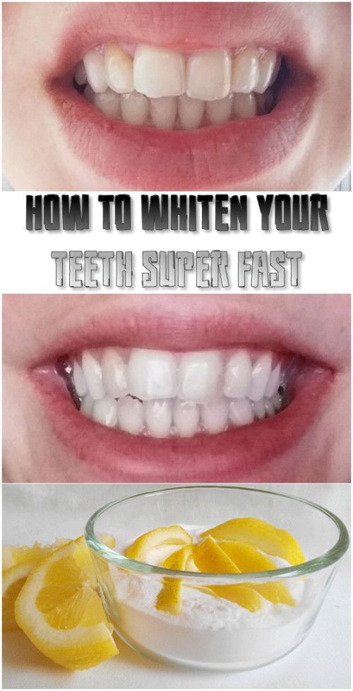 How to whiten your teeth super fast health news