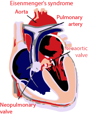 Eisenmenger's syndrome