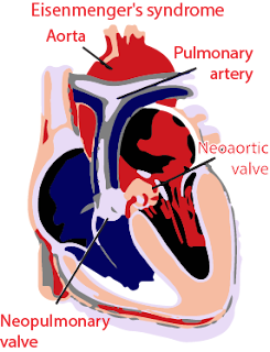 Eisenmenger syndrome