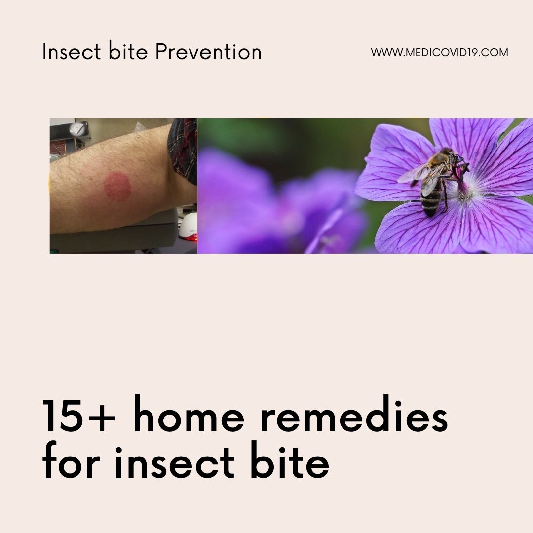 Check out 15+ awesome Home remedies for insect bite, bee sting