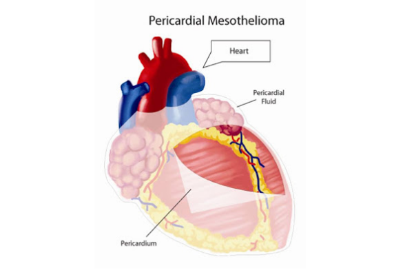 Serene Pericardial Mesothelioma Picture Nature