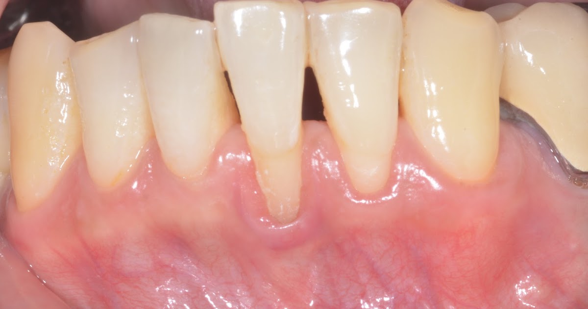Dental implant professional Treating severe gum recession of lower