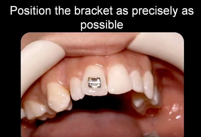 ORTHODONTIC: How important is the position of your orthodontic braces? - Dr. Jean Marc