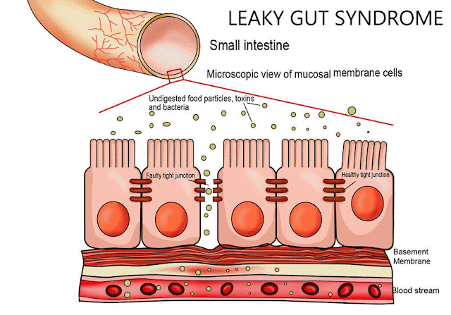 Leaky-gut effect on insulin resistance