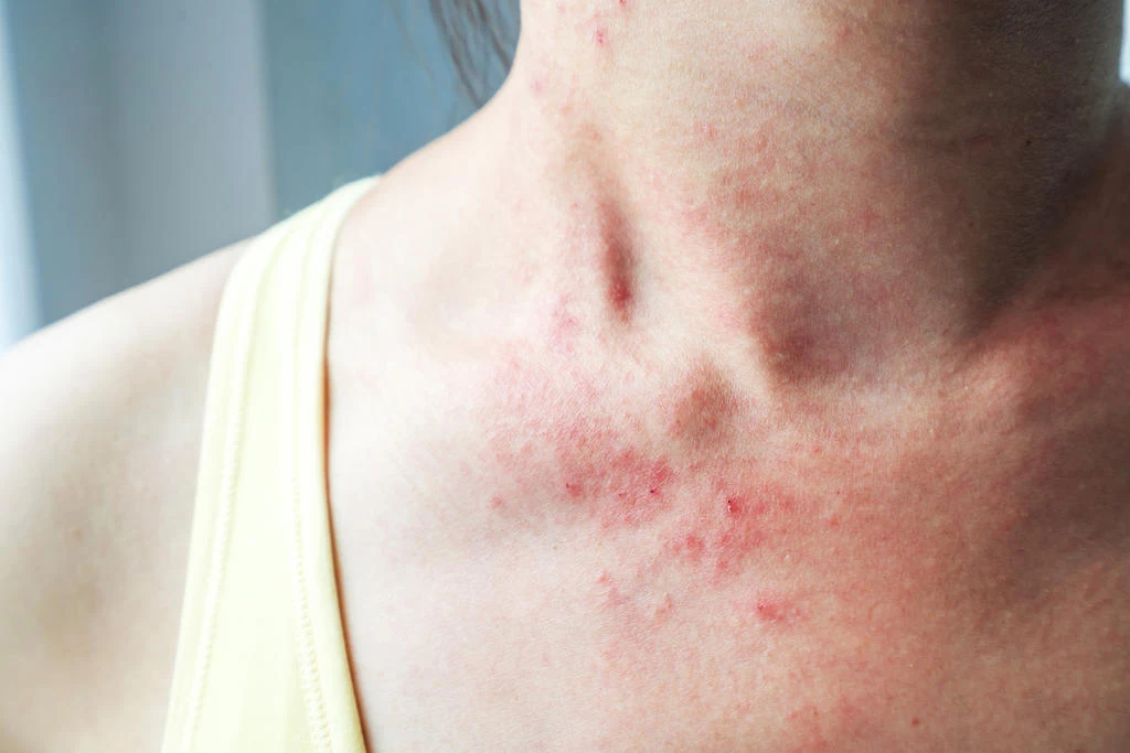 Dermatite: Sintomas, Causas e Tratamento
