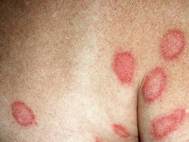 obat eksim gatal sekali