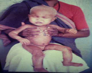 क्वाशियोरकर क्वाशियोरकर