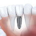 Trồng răng implant và những lưu ý 