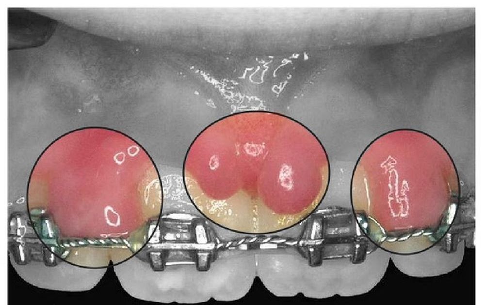 ORTHODONTICS Why Is My Gum Growing Over My Braces? Directorio