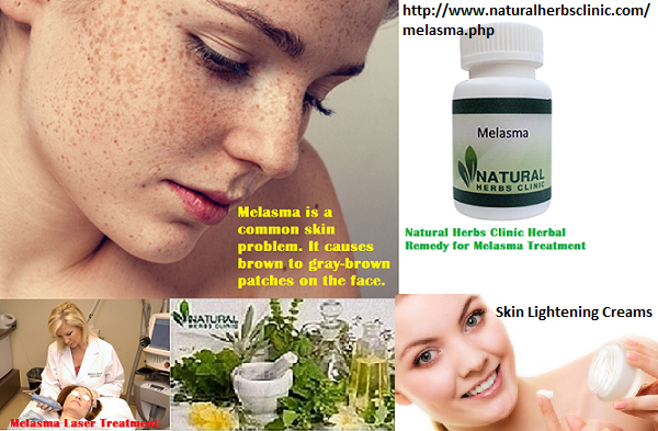 Melasma treatment laser Melasma Laser Treatment