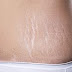 Stretch Marks : Causes, Solutions To Get Rid Of Stretch Marks.