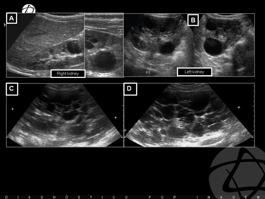 MEDICAL ULTRASOUND POLYCYSTIC KIDNEY medical-ultrasound-polycystic-kidney