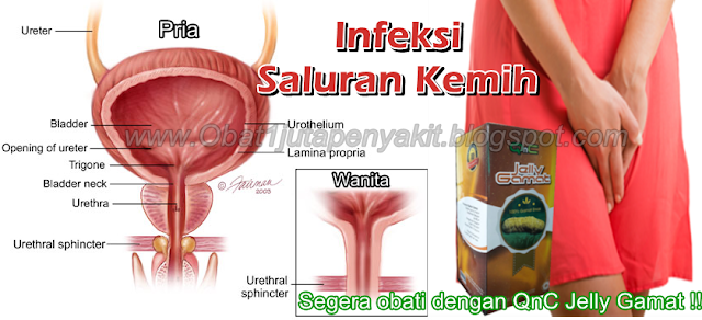 Obat Infeksi Saluran Kemih Tradisional, 100% Terbukti MANJUR Menyembuhkan Infeksi Saluran Kemih Obat Infeksi Saluran Kemih Tradisional, 100% Terbukti MANJUR Menyembuhkan Infeksi Saluran Kemih