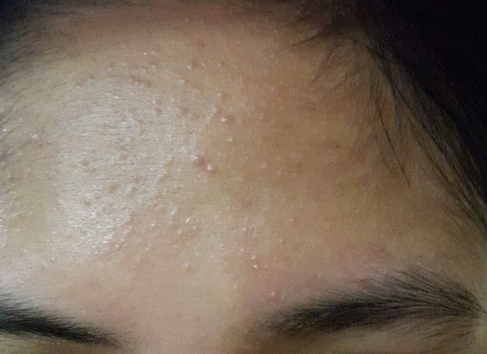 Menghilangkan Bruntusan Ampuh Ferisha Aresti